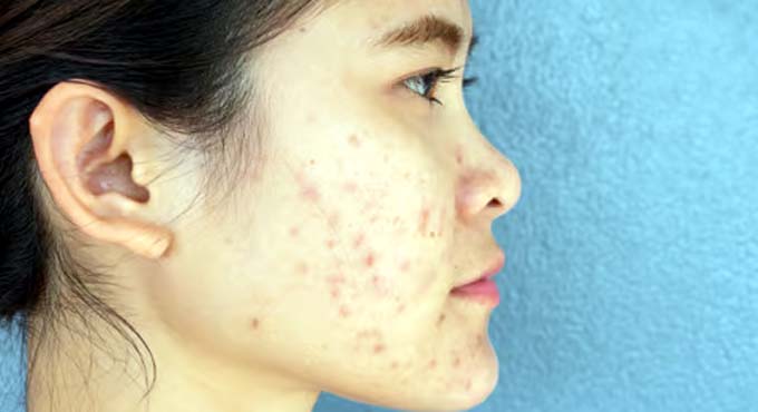 ব্রণ থেকে মুক্তি পেতে ত্বকে লাগান ৪ ভেষজ