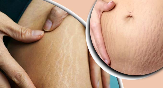 স্ট্রেস মার্কস দূর করার ঘরোয়া উপায়