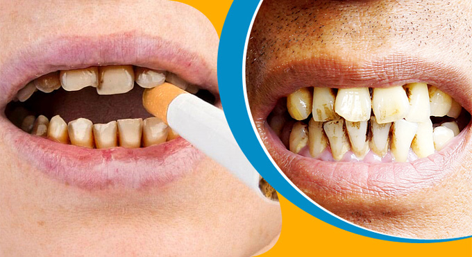 ধূমপায়ীদের জন্য দাঁতের হলদে ছোপ তোলার ঘরোয়া টোটকা