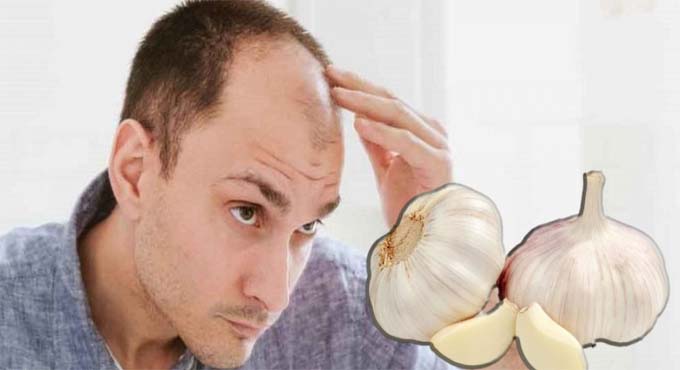 টাক পড়া আটকাতে ব্যবহার করুন রসুন