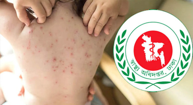 হাম উপসর্গে আরো ৩ শিশুর মৃত্যু, আক্রান্ত ১০৬১